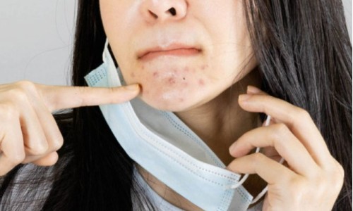 Do Surgical Mask Cause Acne?